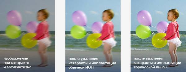 Интраокулярные линзы (иол): особенности, материалы изготовления