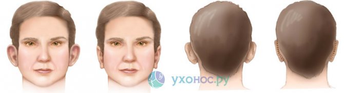 Лопоухость. причины, возможные последствия и профилактика. как избавиться