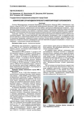 Фиброзирующий альвеолит: симптомы и признаки