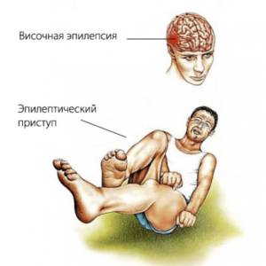 Виды эпилепсии