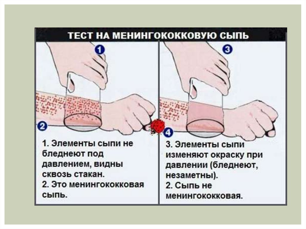 Менингококковая инфекция, менингококцемия: этиология, клиника, лечение, профилактика