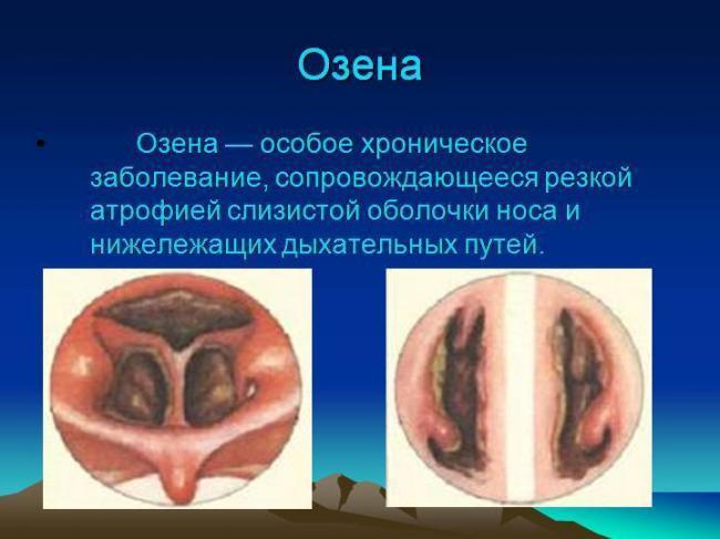 Ринит атрофический - симптомы болезни, профилактика и лечение ринита атрофического, причины заболевания и его диагностика на eurolab