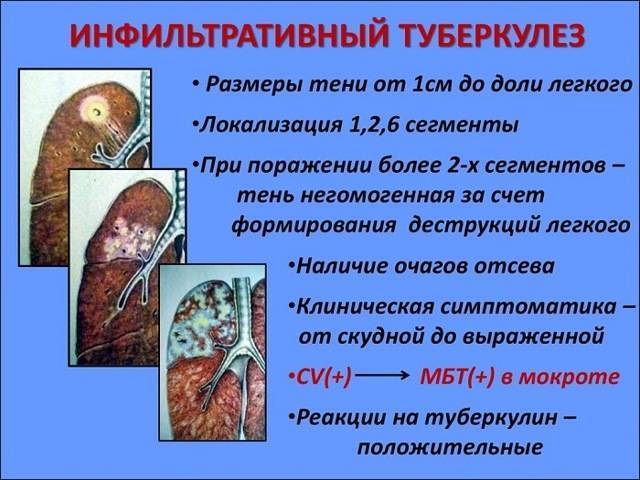 Что такое инфильтративный туберкулез легкого, заразен он или нет? симптомы, лечение, диагностика