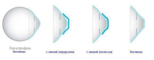 Контактные линзы ночные линзы paragon 100 - отзывы