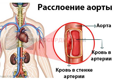 Аневризма брюшной аорты. причины, симптомы, признаки, диагностика и лечение патологии