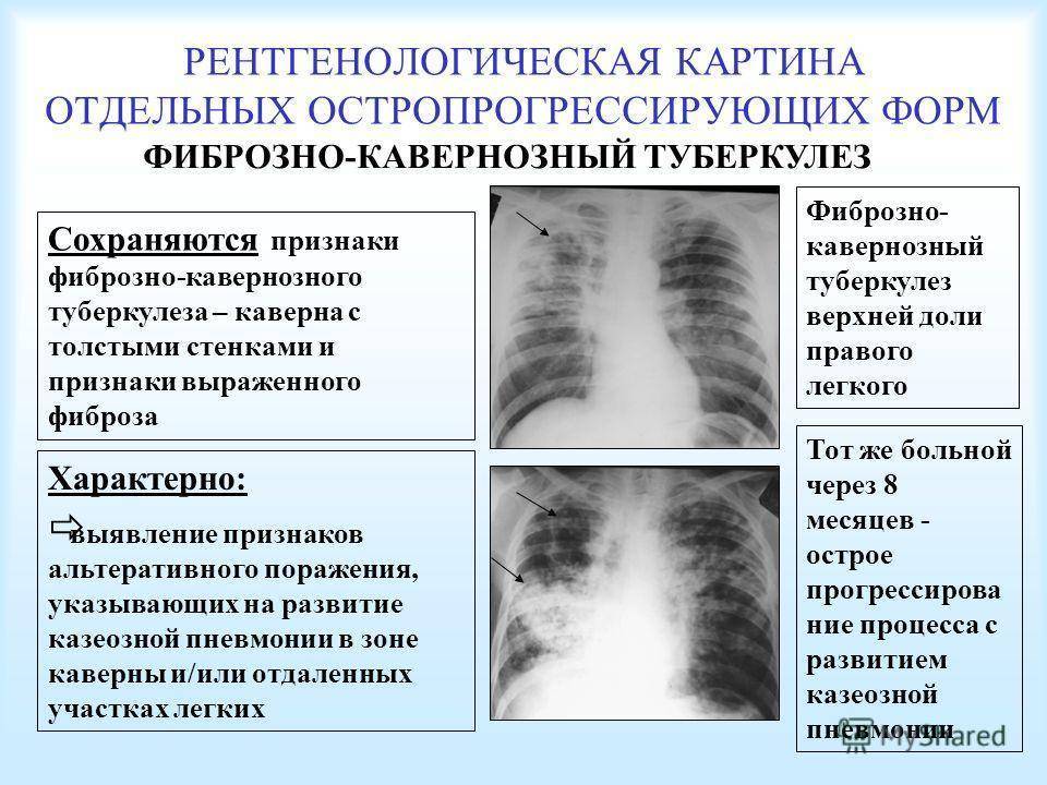Кавернозный туберкулез легких: особенности течения