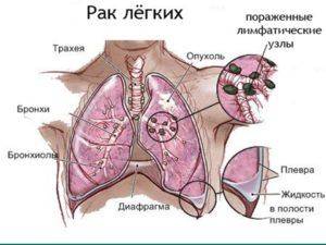 Очаги на кт легких