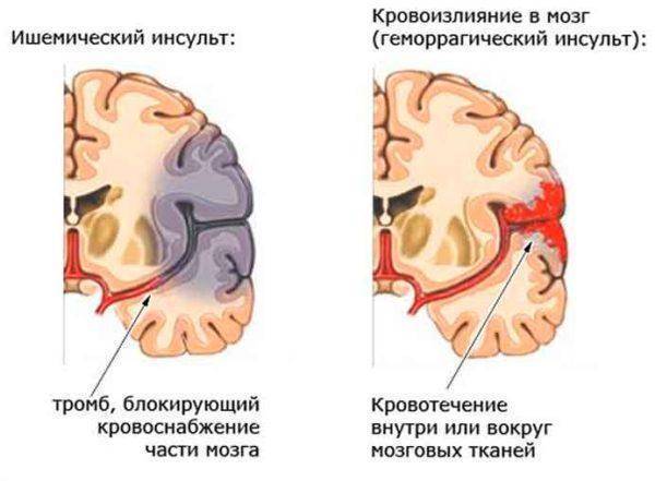 Стеноз сосудов в шейном отделе позвоночника