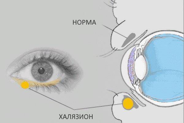 Воспаление нижнего века народные средства