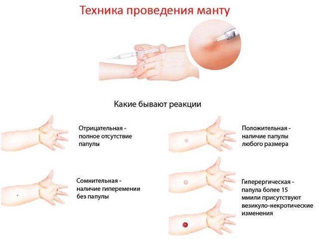Что обозначает отрицательная реакция манту?