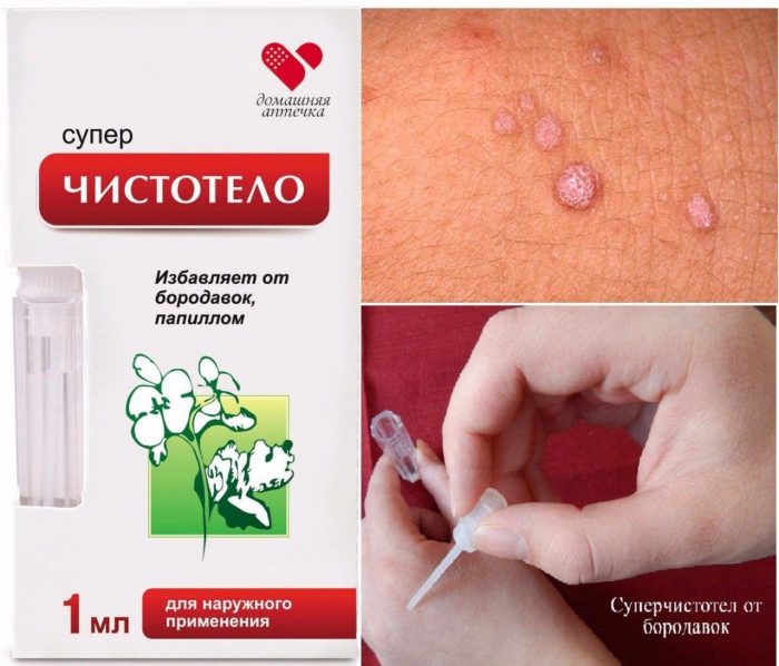 "суперчистотел" от папиллом: отзывы врачей и аналоги