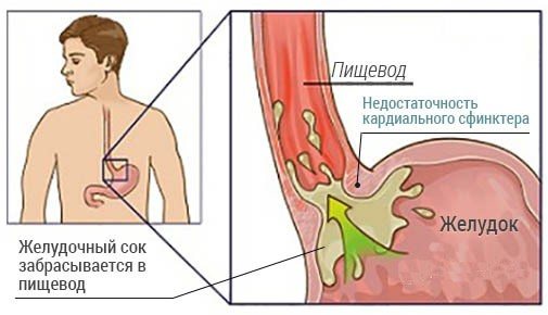 Несмыкание кардии желудка лечение народными средствами
