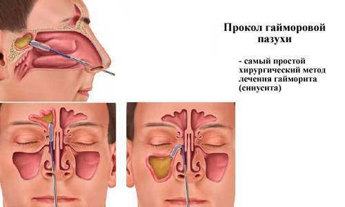 Лечение гайморита народными средствами, лекарствами и процедурами