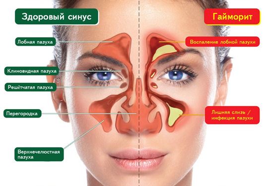 Эффективное лечение гайморита народными средствами - 26 рецептов!