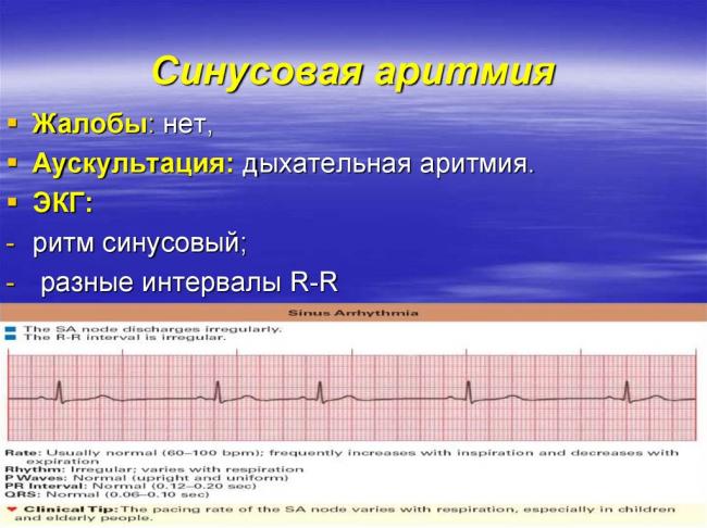 Синусовая брадикардия у детей: первопричины развития, признаки на экг, лечение
