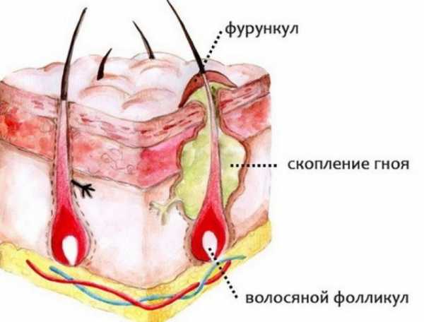 Об уплотнениях и шишках на лице под кожей: причины появления, способы избавления