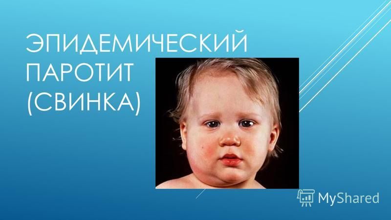 Эпидемический паротит: симптомы, лечение, осложнения и профилактика