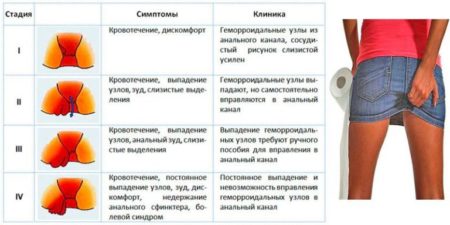 Геморрой – причины возникновения у мужчин и женщин, от чего появляется геморрой после родов?