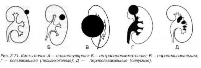 Рассасывание кисты в почке