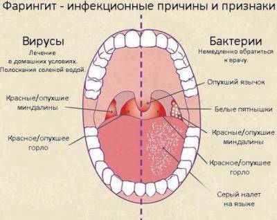 Лечим трахеит — симптомы и виды воспаления слизистой оболочки трахеи