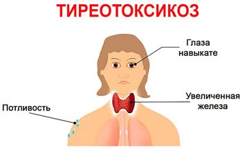 Хаит щитовидной железы: чем опасно хроническое воспаление