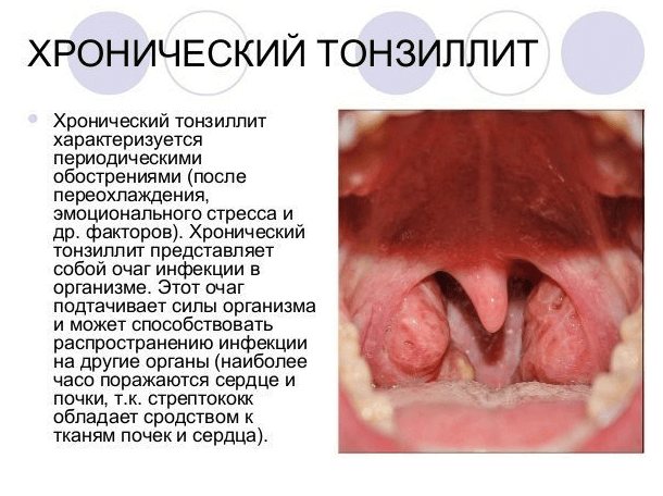 Как вылечить хронический тонзиллит в домашних условиях