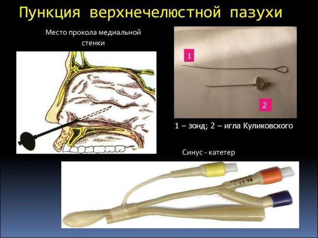 Как делается процедура прокола при гайморите, возможные последствия и что делать дальше