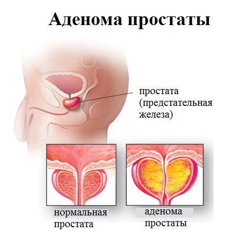 Ранопрост: состав, показания, дозировка, побочные эффекты