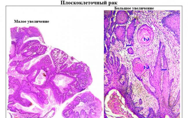 Аденокарцинома - adenocarcinoma - qwe.wiki