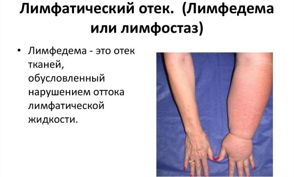 Лимфедема – как лечить отеки рук и ног, прогноз заболевания