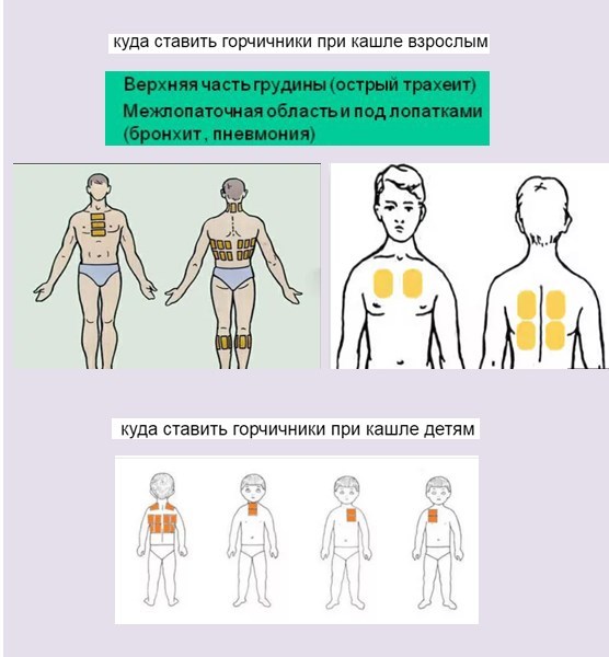 Куда и как ставить горчичники правильно. можно ли ставить банки при бронхите, пневмонии, температуре