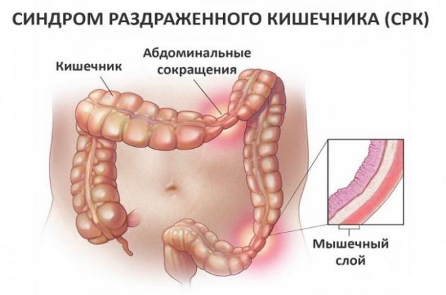 Аналоги таблеток колофорт