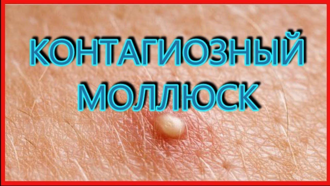 Контагиозный моллюск: пути заражения, методы удаления