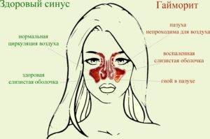 Как дома вылечить гайморит? - самые эффективные методы лечения недуга