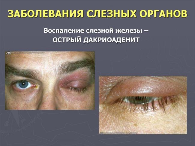 Лечение слезной железы фото