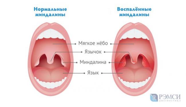 Воспаление гланд: методы лечения