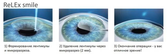 Перечень ограничений после лазерной коррекции зрения