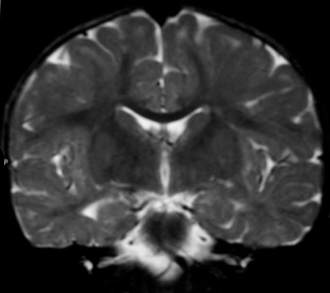 Leukodystrophy - leukodystrophy