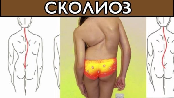 Что такое сколиоз у детей и как его вылечить?