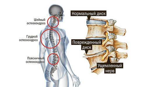 Лечение и операция лазером грыжи дисков шейного отдела позвоночника, удаление и вапоризация