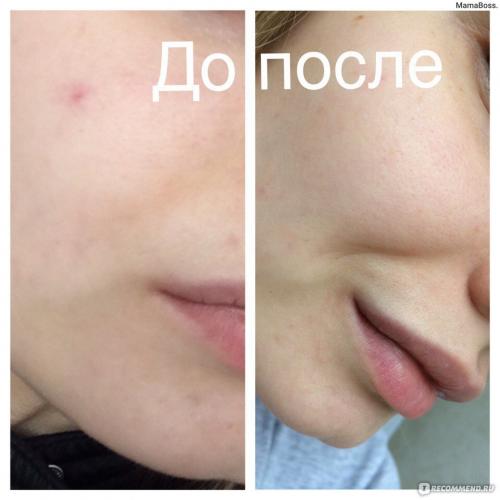 Звездочки мои сосудистые. лечение купероза лазером