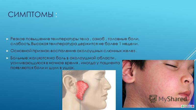 Паротит: симптомы, лечение, вакцинация