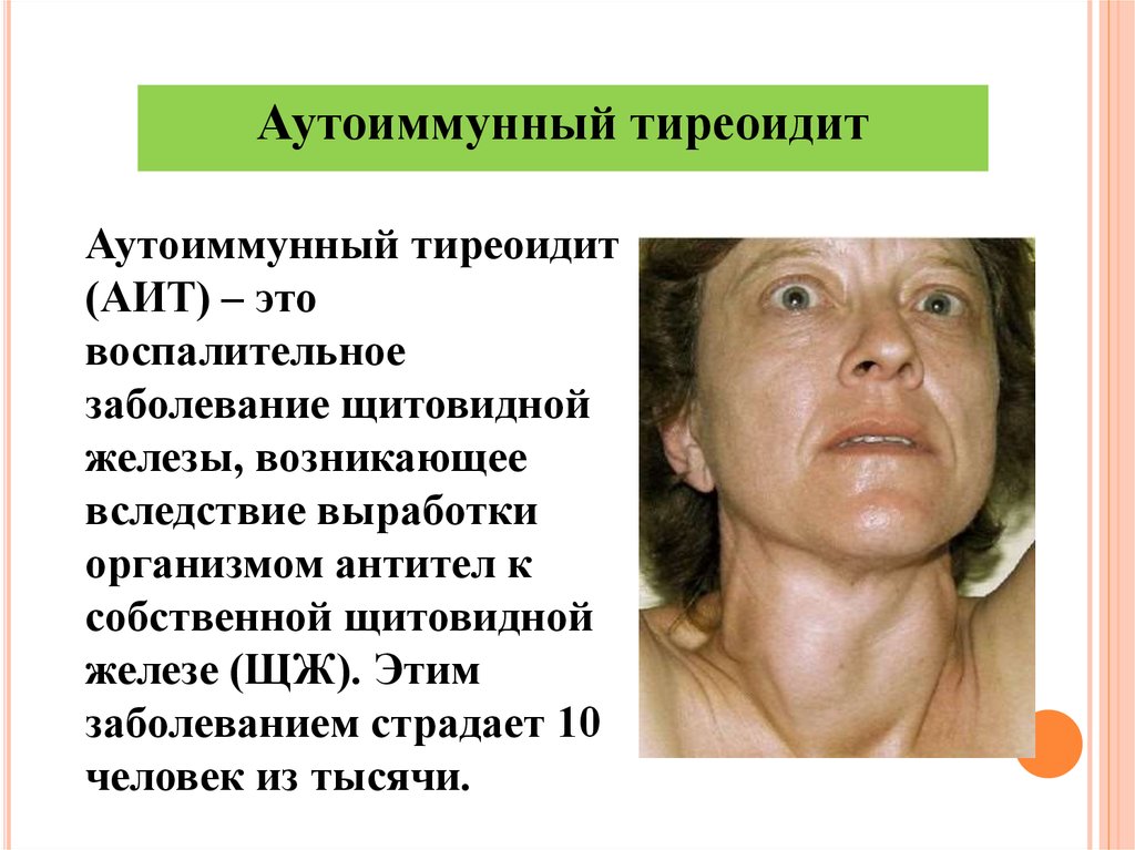 Тиреоидит щитовидной железы. причины, симптомы, диагностика и лечение