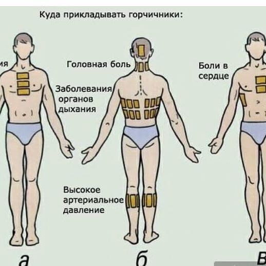 Можно ли ставить горчичники и банки при бронхите и пневмонии
