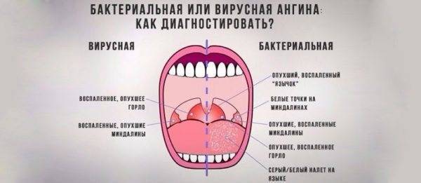 Как понять, ангина у больного вирусная, или бактериальная?