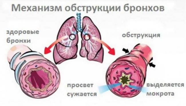 Бронхит у детей: 5 проверенных методов лечение народными средствами
