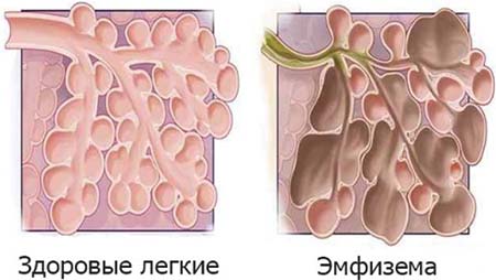 Эмфизема легких