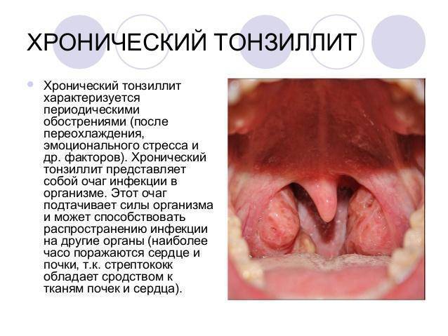 Закаливание горла при хроническом тонзиллите
