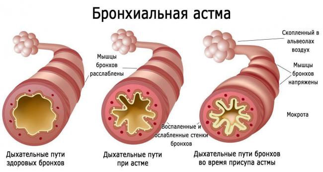 Симптомы и лечение одышки при бронхиальной астме