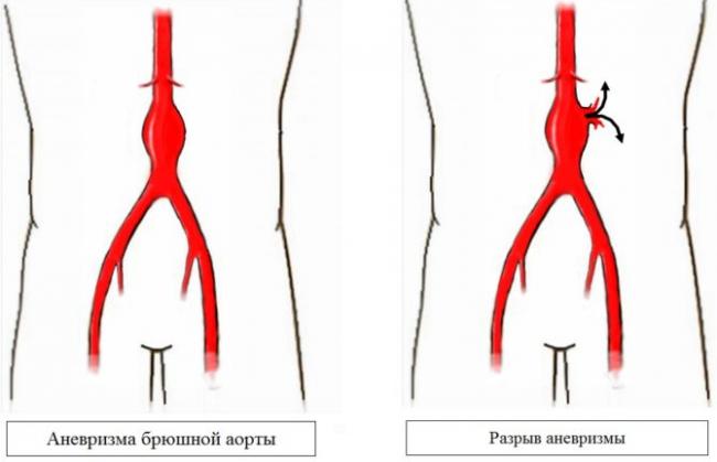 Аневризма брюшной аорты. причины, симптомы, признаки, диагностика и лечение патологии